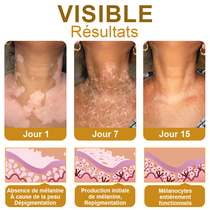 Dobshow™ BeeVenom Crème de traitement du vitiligo
