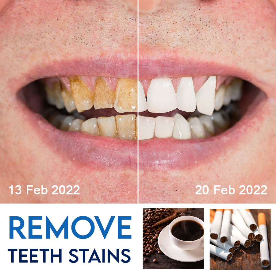 Dobshow™ Instant Teeth Whitening Gel