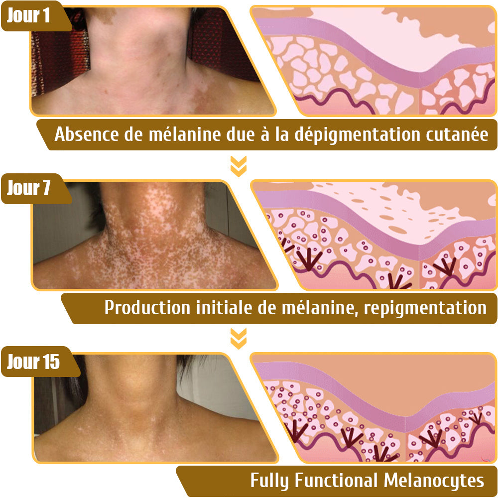 Dobshow™ BeeVenom Crème de traitement du vitiligo