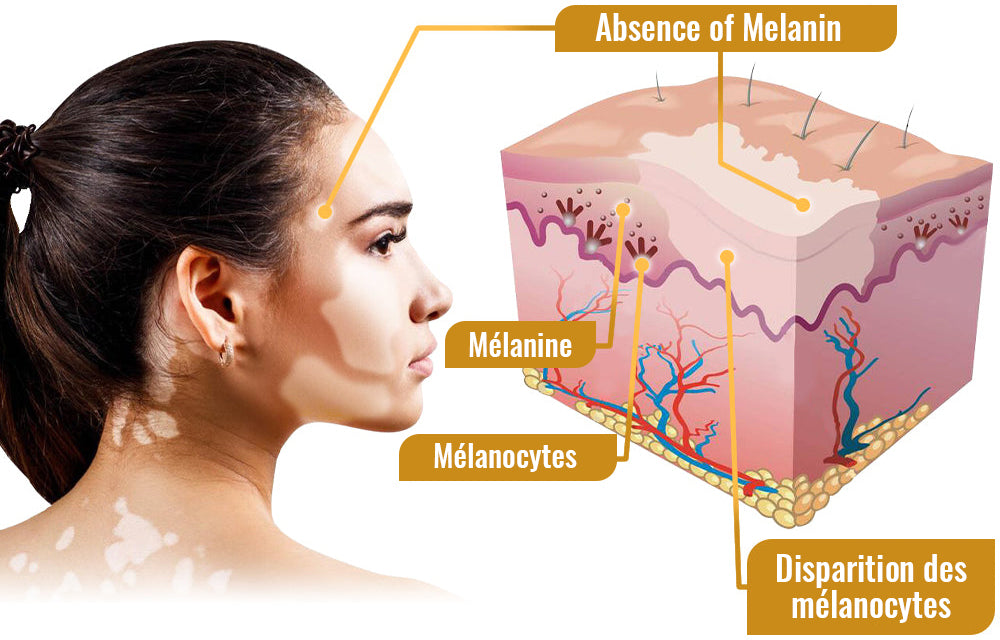 Dobshow™ BeeVenom Crème de traitement du vitiligo