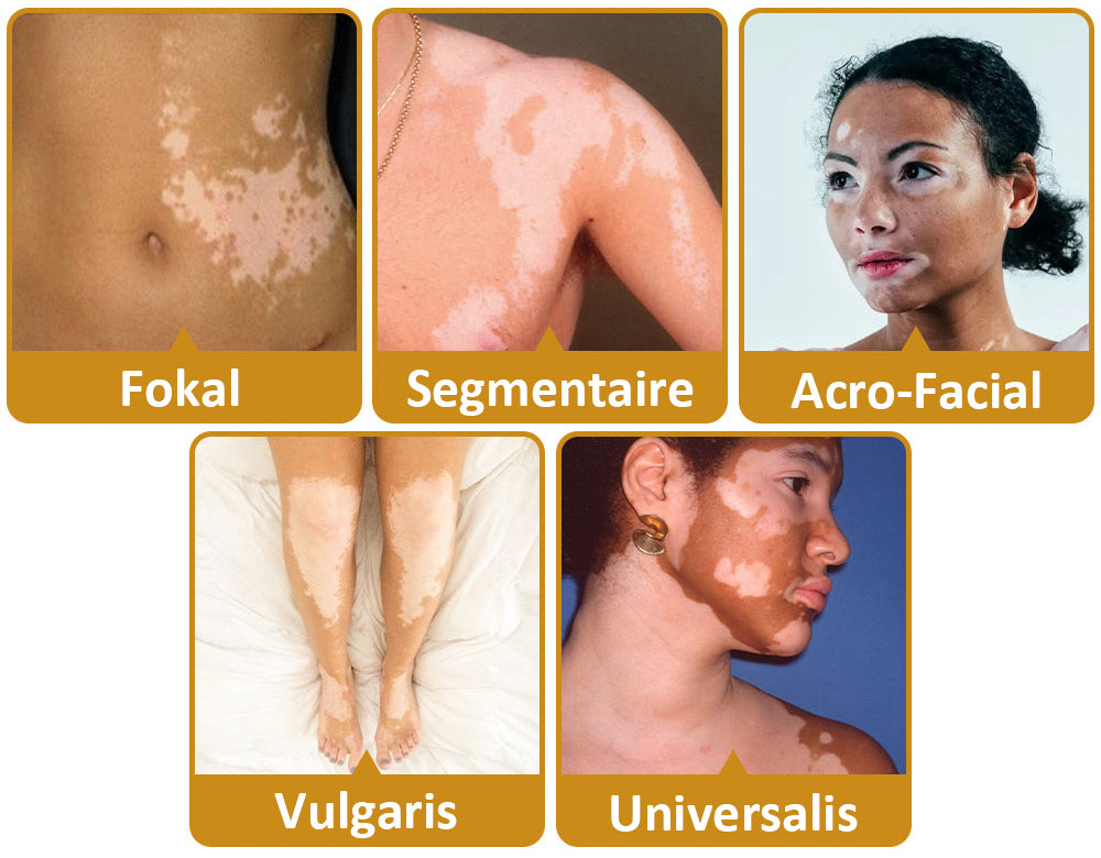 Dobshow™ BeeVenom Crème de traitement du vitiligo